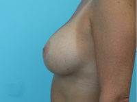 Breast Augmentation