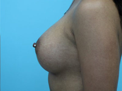 Breast Augmentation