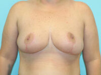 Breast Reduction