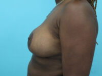 Breast Reduction