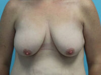 Augmentation & Mastopexy