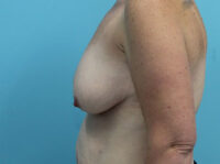 Augmentation & Mastopexy