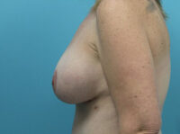 Augmentation & Mastopexy