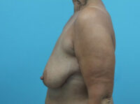 Augmentation & Mastopexy