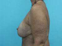 Augmentation & Mastopexy