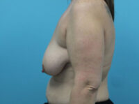 Augmentation & Mastopexy