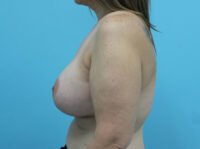 Augmentation & Mastopexy