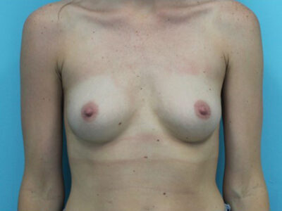 Breast Augmentation