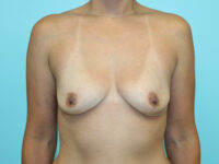 Breast Augmentation