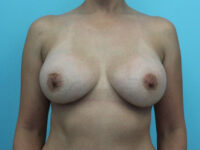 Breast Augmentation