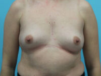 Breast Augmentation