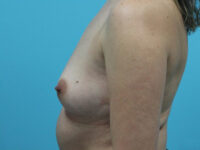 Breast Augmentation