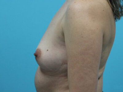 Breast Augmentation