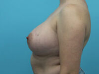 Breast Augmentation