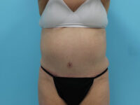 Abdominoplasty