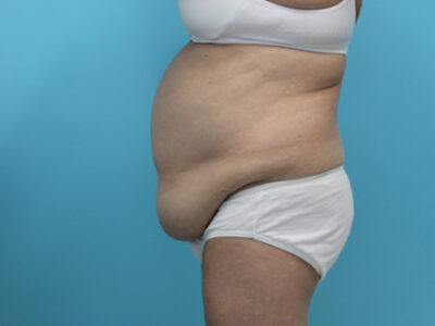 Abdominoplasty