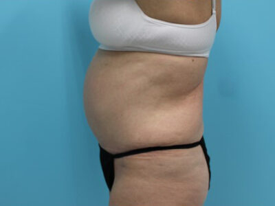 Abdominoplasty