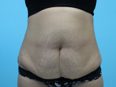 Abdominoplasty