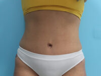 Abdominoplasty