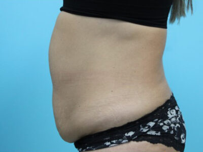 Abdominoplasty