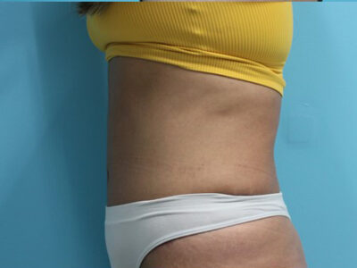 Abdominoplasty