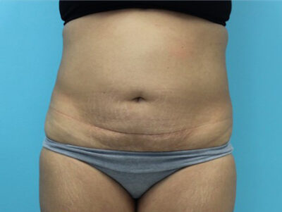 Abdominoplasty