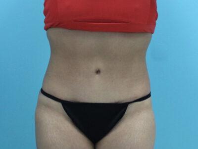 Abdominoplasty