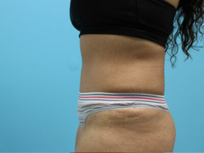 Abdominoplasty