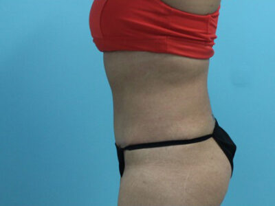 Abdominoplasty