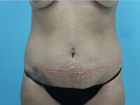 Abdominoplasty