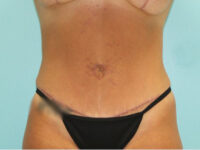 Abdominoplasty