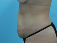 Abdominoplasty