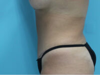 Abdominoplasty