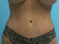 Abdominoplasty