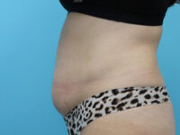 Abdominoplasty