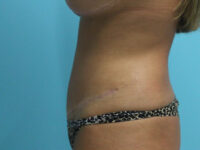 Abdominoplasty