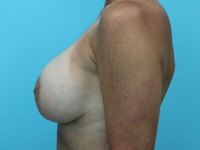 Augmentation & Mastopexy