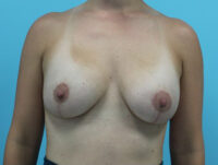 Augmentation & Mastopexy