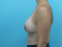 Augmentation & Mastopexy