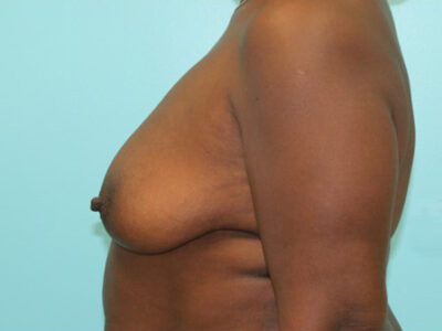 Augmentation & Mastopexy