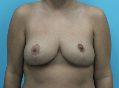 Breast Augmentation