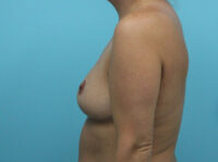 Breast Augmentation