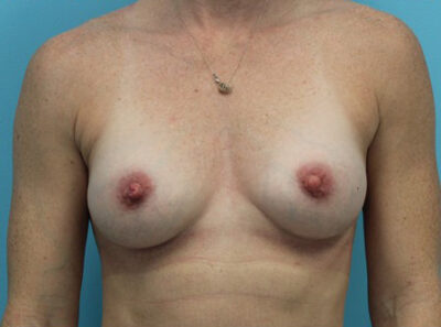 Breast Augmentation