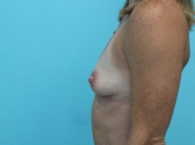 Breast Augmentation