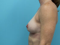 Breast Augmentation