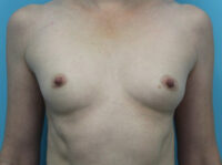 Breast Augmentation