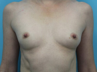 Breast Augmentation