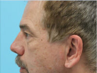 Blepharoplasty