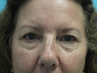 Blepharoplasty