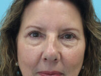 Blepharoplasty